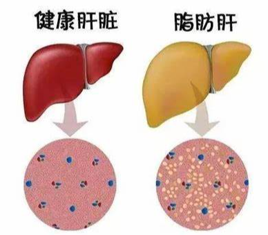 脂肪肝可以治疗